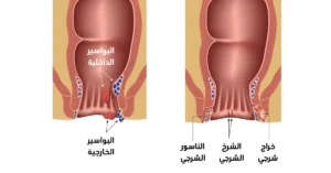 الفرق بين الشرخ والبواسير